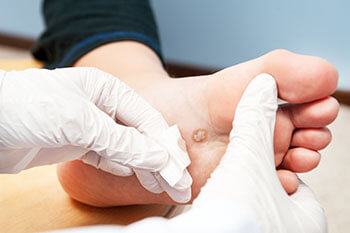 Plantar warts treatment in the West Hollywood, CA 90048 area