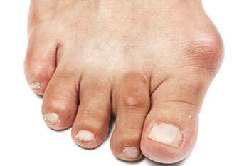 bunions treatment in the West Hollywood, CA 90048 area