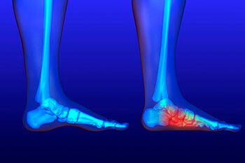 Flat feet and Fallen Arches treatment in the West Hollywood, CA 90048 area