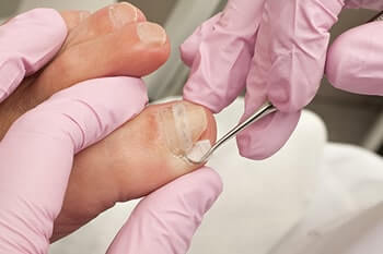 Ingrown toenails treatment in the West Hollywood, CA 90048 area