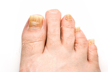 fungus toenails treatment in the West Hollywood, CA 90048 area